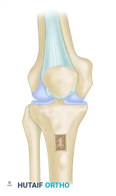 ACHILLES TENDON ALLOGRAFT Surgical Diagram