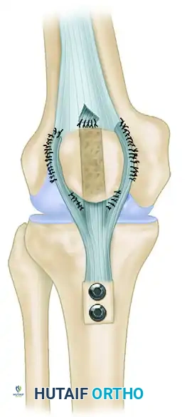 ACHILLES TENDON ALLOGRAFT Surgical Diagram