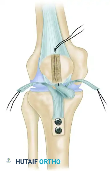 ACHILLES TENDON ALLOGRAFT Surgical Diagram