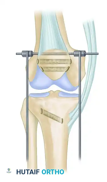 ACHILLES TENDON ALLOGRAFT Surgical Diagram