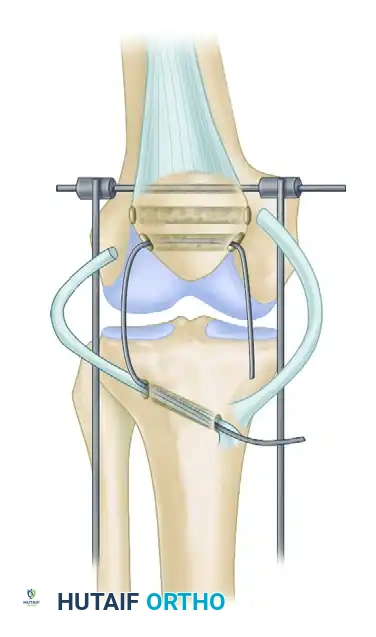 ACHILLES TENDON ALLOGRAFT Surgical Diagram