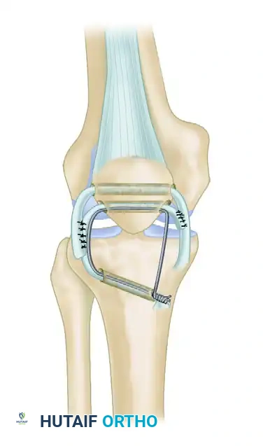 ACHILLES TENDON ALLOGRAFT Surgical Diagram