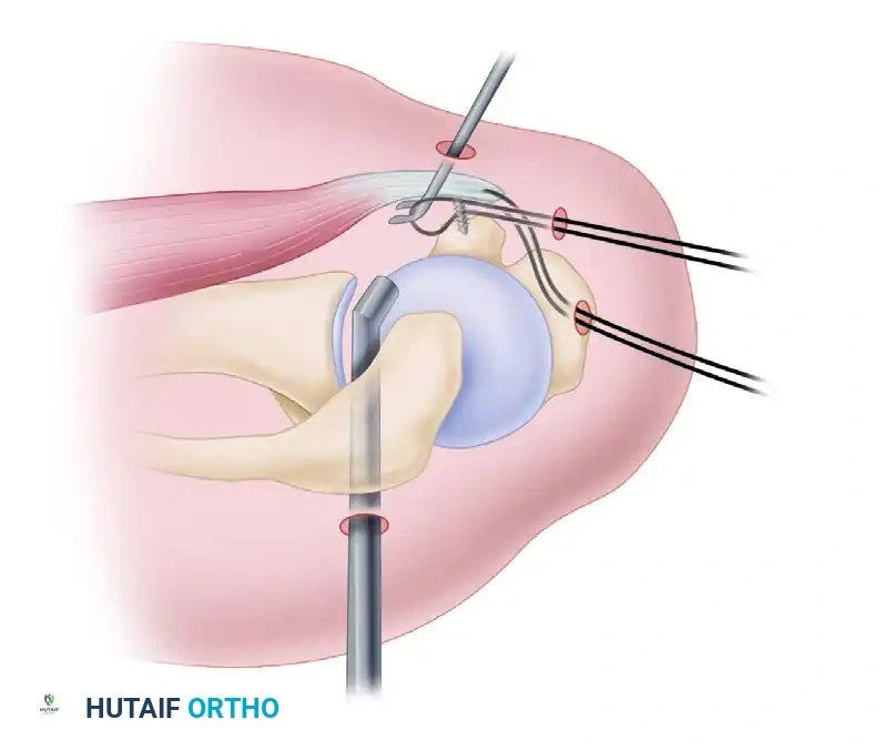 Subscapularis muscle