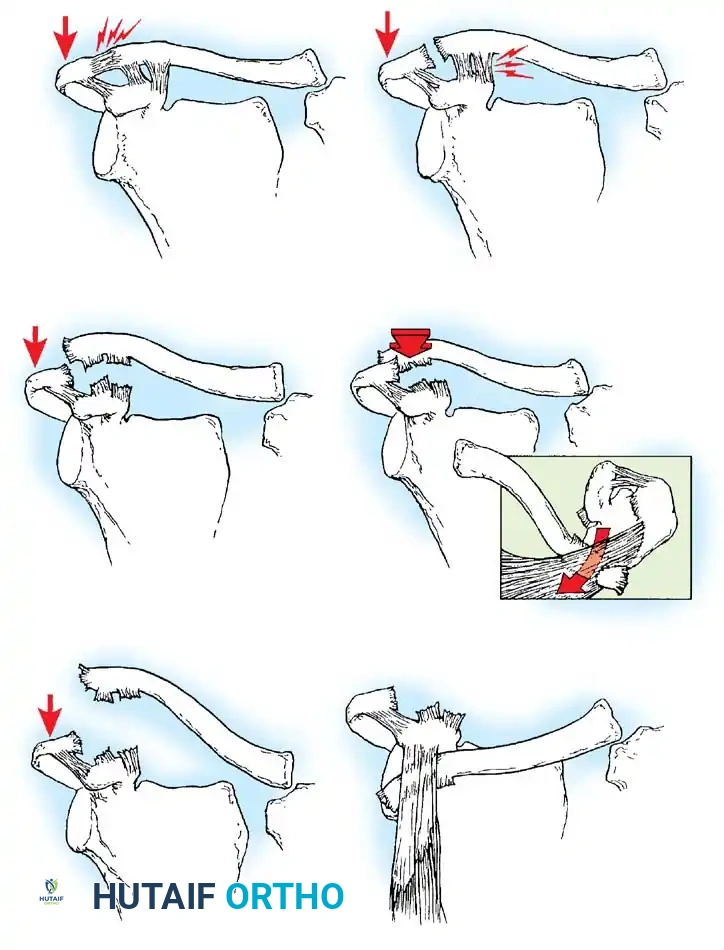 Type I                                         Type II