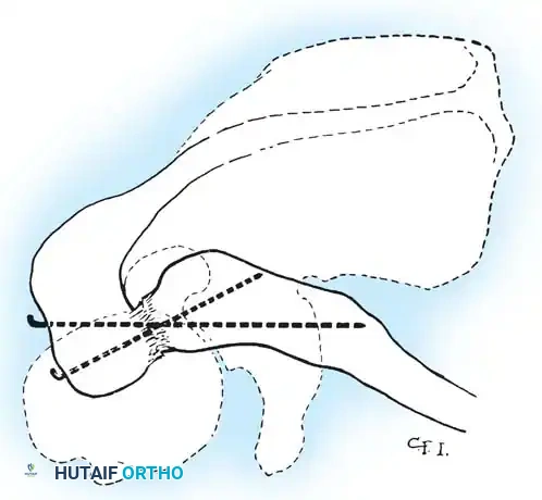 ACROMIOCLAVICULAR JOINT Surgical Diagram
