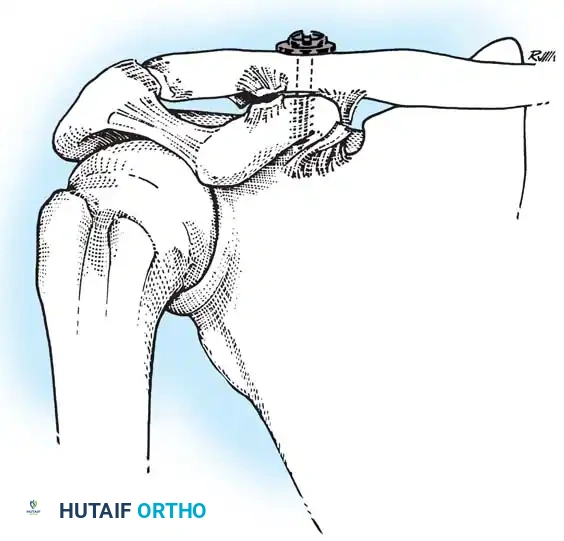 ACROMIOCLAVICULAR JOINT Surgical Diagram