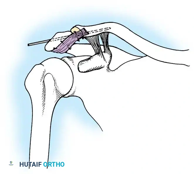 Fig. 58-6 Neviaser technique for repairing dislocations of acromioclavicular joint