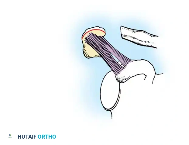 Copeland and Kessel method of detaching coracoacromial ligament