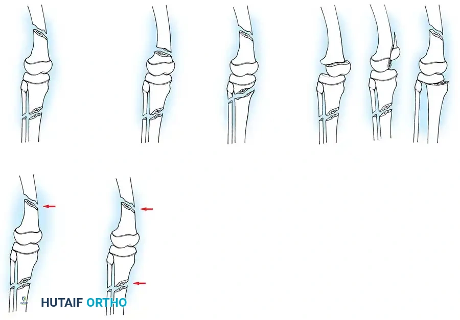 Comprehensive Management of Pediatric Knee Dislocations and Proximal Tibial Fractures