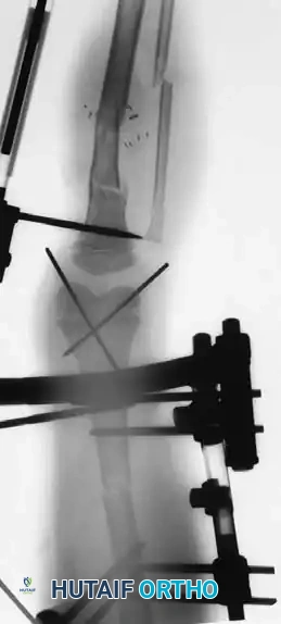 ACUTE DISLOCATIONS OF THE KNEE Surgical Diagram