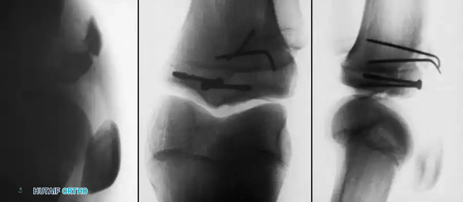 ACUTE DISLOCATIONS OF THE KNEE Surgical Diagram