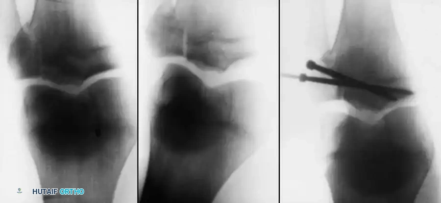 ACUTE DISLOCATIONS OF THE KNEE Surgical Diagram
