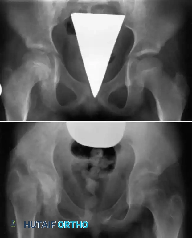 Acute Hematogenous Osteomyelitis: Comprehensive Diagnosis and Surgical Management