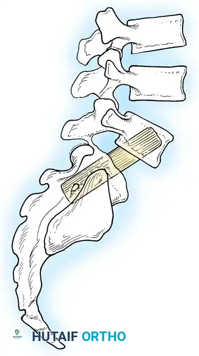 Surgical Diagram - Transsacral Dowel Graft