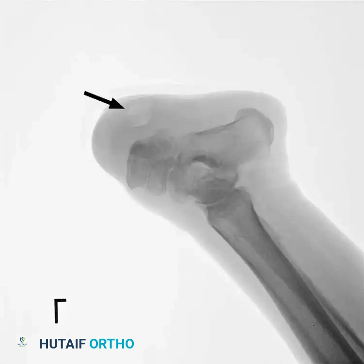 Recurrent seroma on lateral radiograph