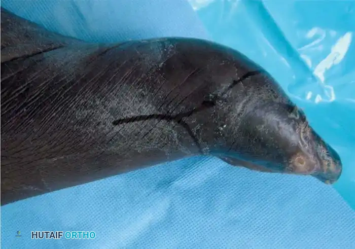 Severe ischemia of hallux B/C