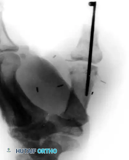 دليل شامل حول جراحة بتر أصابع اليد وإعادة البناء