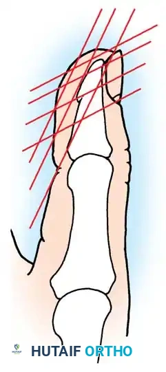 الدليل الشامل لعلاج وجراحة بتر الإبهام والأصابع المتعددة
