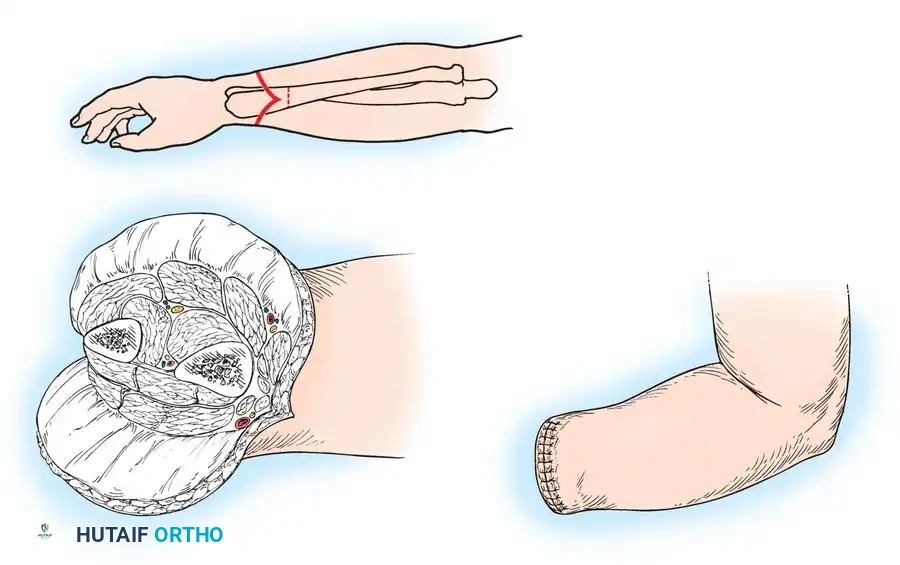 Amputations of the Upper Extremity Surgical Diagram