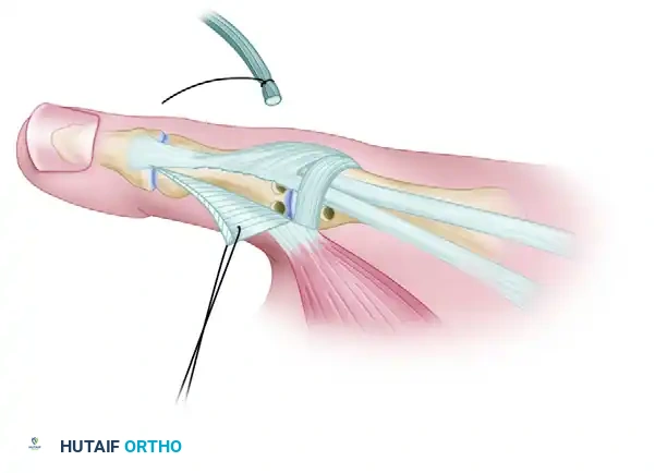 ANATOMICAL GRAFT RECONSTRUCTIONS Surgical Diagram