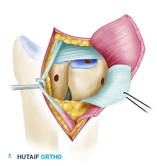 ANATOMICAL RECONSTRUCTION OF THE DISTAL RADIOULNAR LIGAMENTS Surgical Diagram