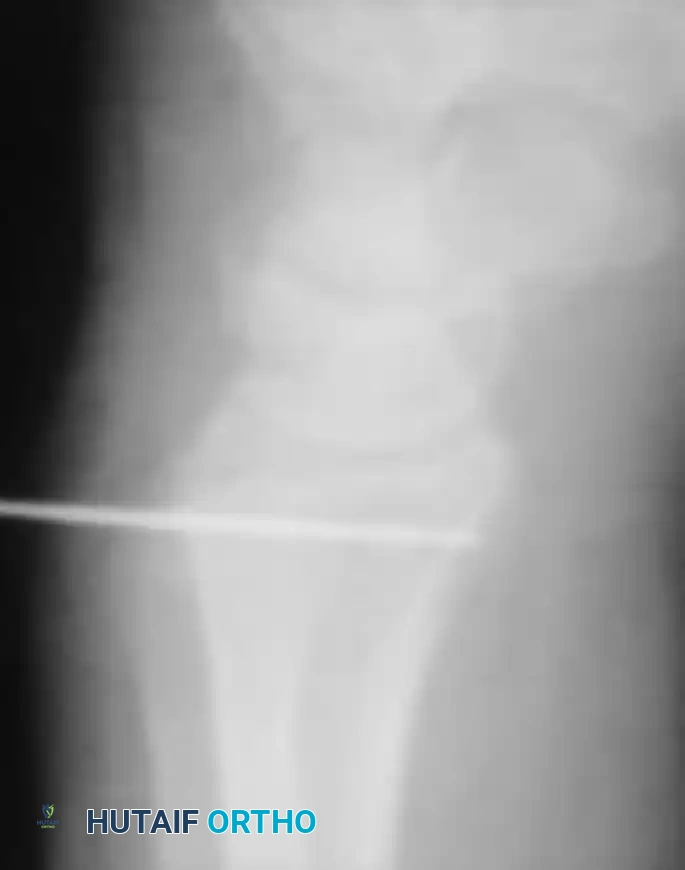 Anatomical DRUJ Reconstruction: Adams-Berger Technique