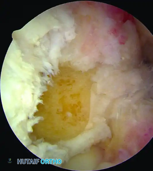 ANATOMICAL SINGLE-BUNDLE ENDOSCOPIC ANTERIOR CRUCIATE LIGAMENT RECONSTRUCTION USING BONE-PATELLAR TENDON-BONE GRAFT Surgical Diagram