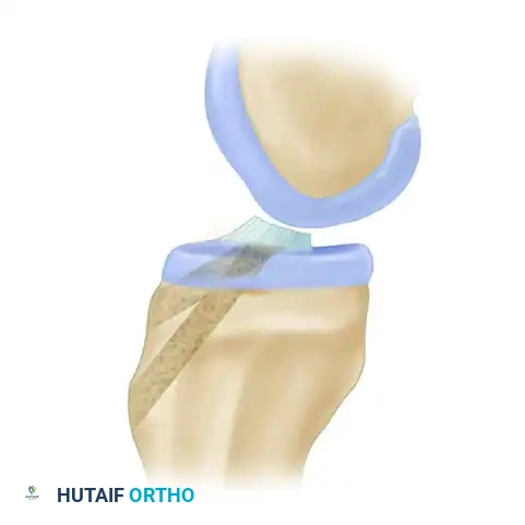 ANATOMICAL SINGLE-BUNDLE ENDOSCOPIC ANTERIOR CRUCIATE LIGAMENT RECONSTRUCTION USING BONE-PATELLAR TENDON-BONE GRAFT Surgical Diagram