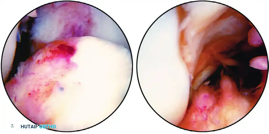 ANATOMICAL SINGLE-BUNDLE ENDOSCOPIC ANTERIOR CRUCIATE LIGAMENT RECONSTRUCTION USING BONE-PATELLAR TENDON-BONE GRAFT Surgical Diagram