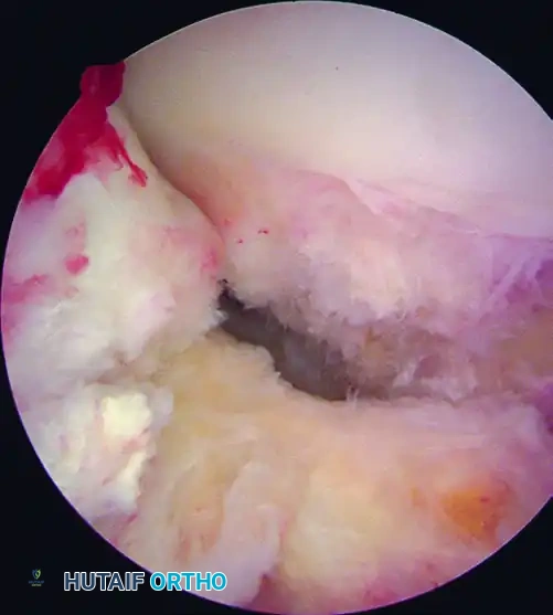 ANATOMICAL SINGLE-BUNDLE ENDOSCOPIC ANTERIOR CRUCIATE LIGAMENT RECONSTRUCTION USING BONE-PATELLAR TENDON-BONE GRAFT Surgical Diagram