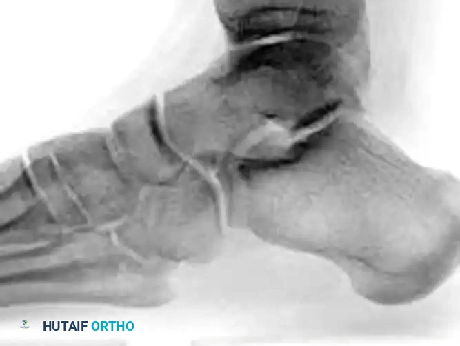 Comprehensive Surgical Management of Talar Head Fractures and Talar Vascular Anatomy