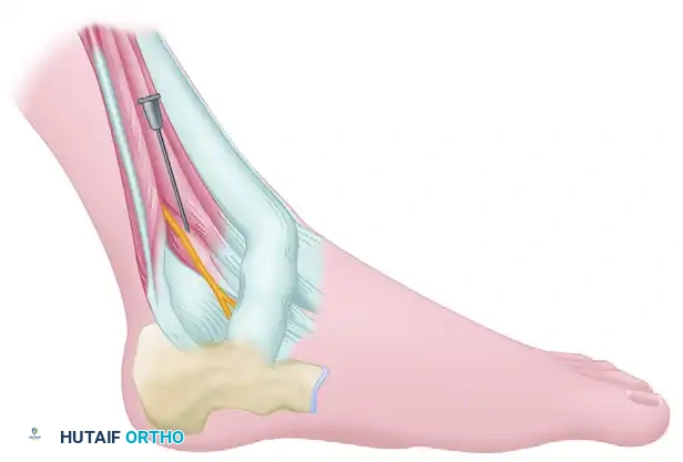 Superficial Peroneal Nerve Block