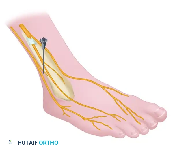 Mastering Regional Anesthesia: Comprehensive Guide to Ankle and Popliteal Sciatic Nerve Blocks