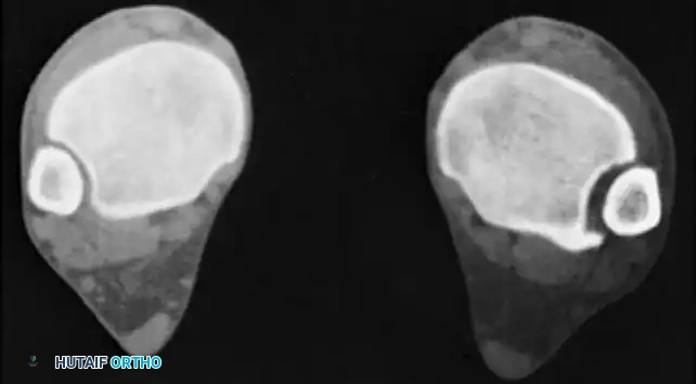 Ankle Malunion Reconstruction: Surgical Techniques & Biomechanics