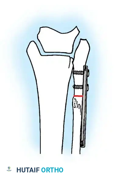 تثبيت شريحة الضغط الديناميكية على الجزء السفلي من الشظية لعمل القطع العظمي