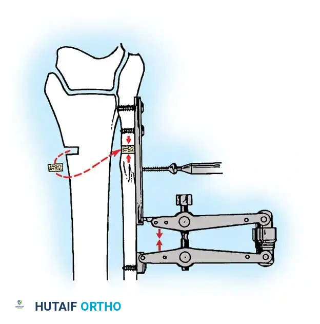 وضع الرقعة العظمية في الفجوة وتطبيق الضغط عبر جهاز الشد وتثبيت المسامير