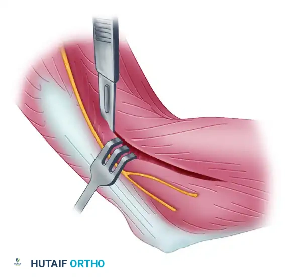 Tip of olecranon is removed