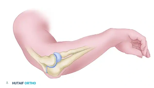 Skin incision for extensile Kocher approach