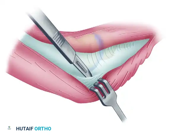Deep fascia is incised along lateral margin of triceps