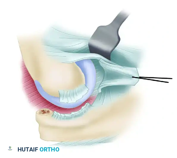 Lateral collateral ligament is identified and released