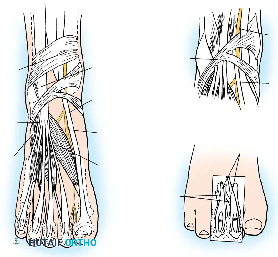 Anterior Tarsal Tunnel Syndrome: Operative Guide