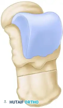 Dwyer Osteotomy Context 1