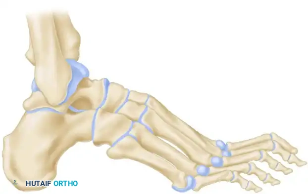 Samilson Osteotomy Diagram A