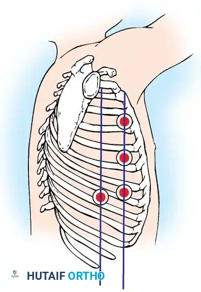 Posterior axillary line Anterior axillary line