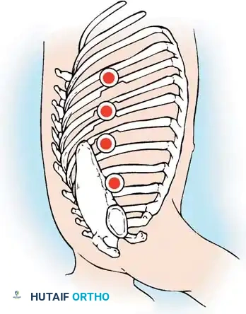 ANTERIOR THORACOPLASTY Surgical Diagram