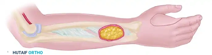 Radial Forearm & Posterior Interosseous Flaps: Surgical Guide