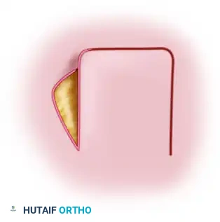 APPLYING SPLIT-THICKNESS GRAFTS Surgical Diagram