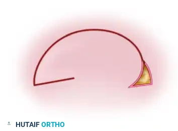 APPLYING SPLIT-THICKNESS GRAFTS Surgical Diagram