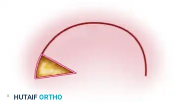 APPLYING SPLIT-THICKNESS GRAFTS Surgical Diagram
