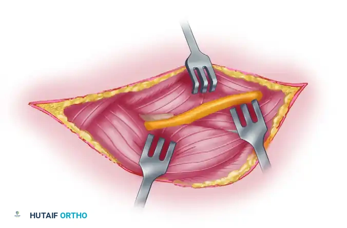 Mastering Surgical Approaches to the Radial and Ulnar Nerves
